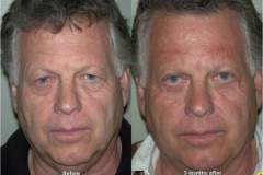 Direct Forehead lift with upper and lower eyelid surgery
