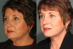 Facelift with Upper Eyelid Surgery