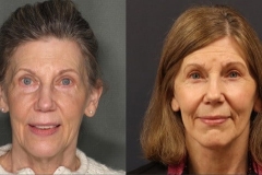 Facelift with Quad (upper and lower) blepharoplasty