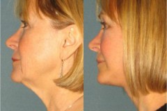 Rapid Recovery Facelift