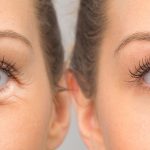 Blepharoplasty in Portland